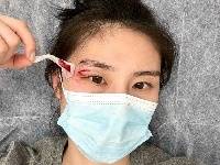 希望无大碍！王思雨晒眼角受伤照：脸上又多个故事